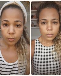  The Incredible Transformation: From Botox to HerbalFaceFood Serum
